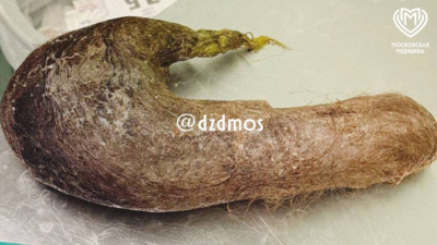 Гигантский волосяной комок вырезали из желудка девочки-подростка - шокирующие фото 02/02/2026 &ndash;